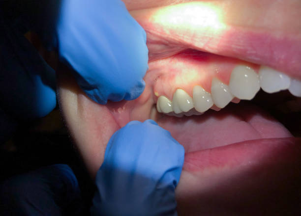 Best Emergency Treatment for Toothache in Roosevelt Park, MI